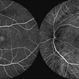 Macular Telangiectasia Type 2 &  CNV Macular Telangiectasia Type 2 &  CNV